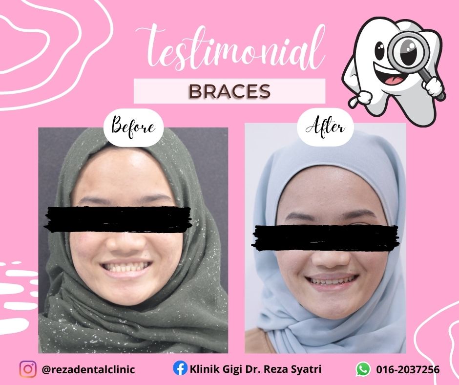 before after braces (1)