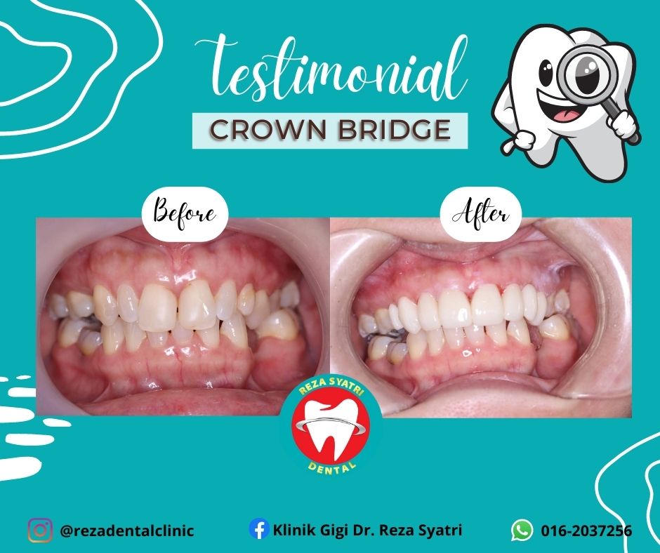 before after crown bridges (1)