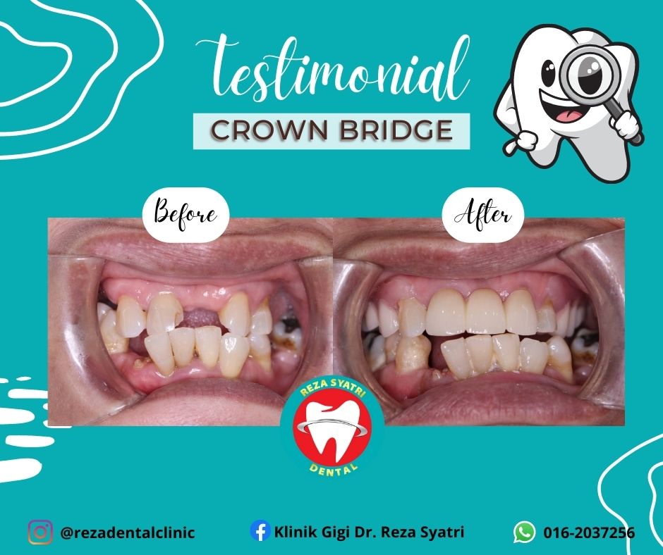 before after crown bridges (2)