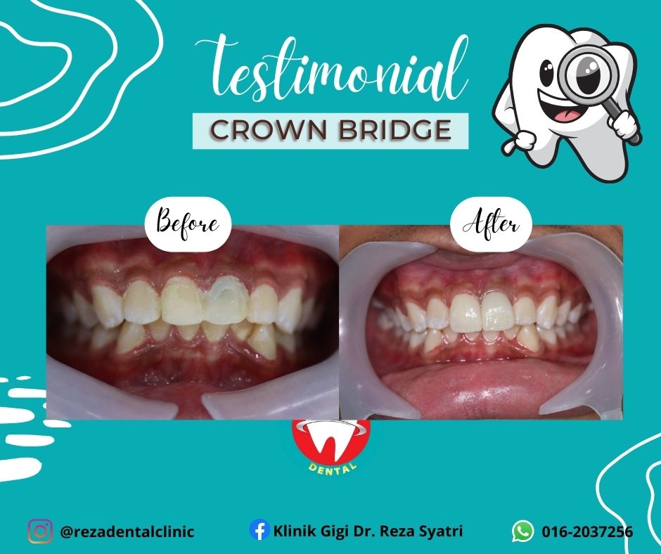 before after crown bridges (3)