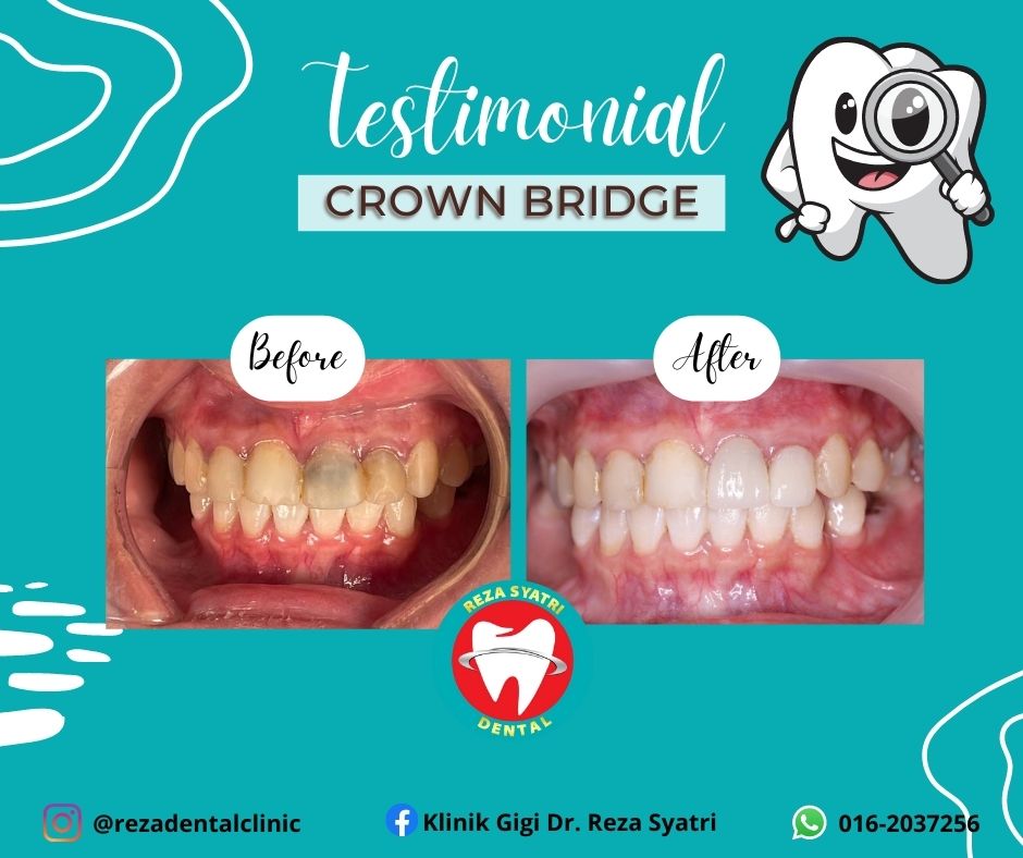 before after crown bridges (4)