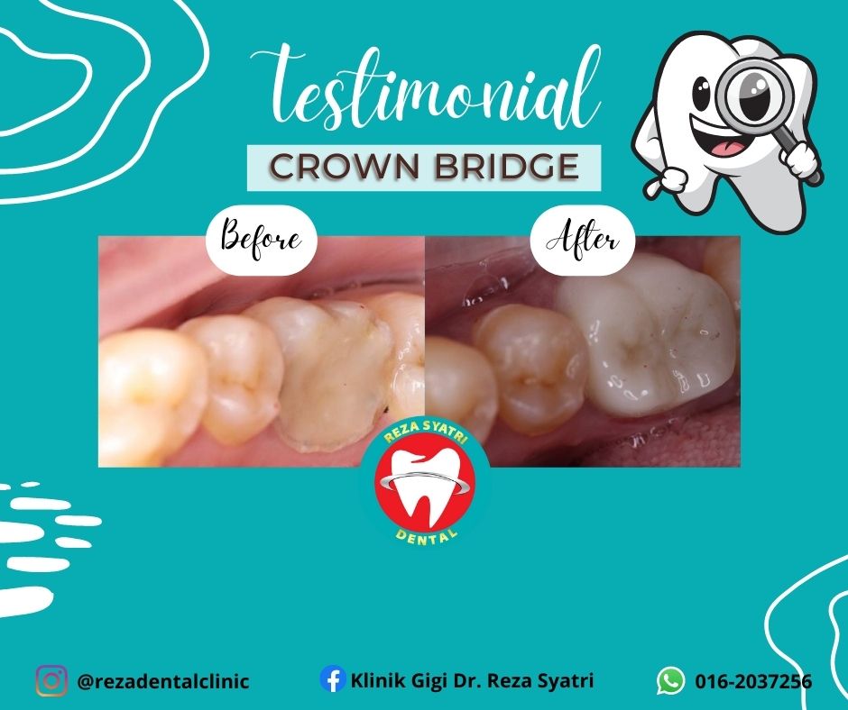 before after crown bridges (6)