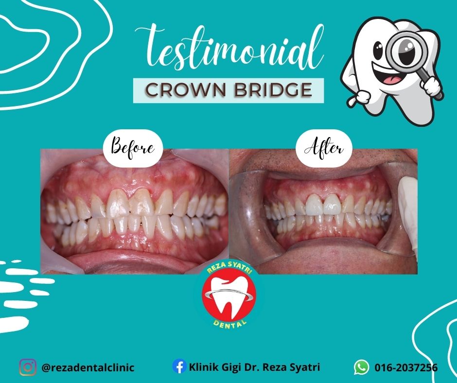 before after crown bridges