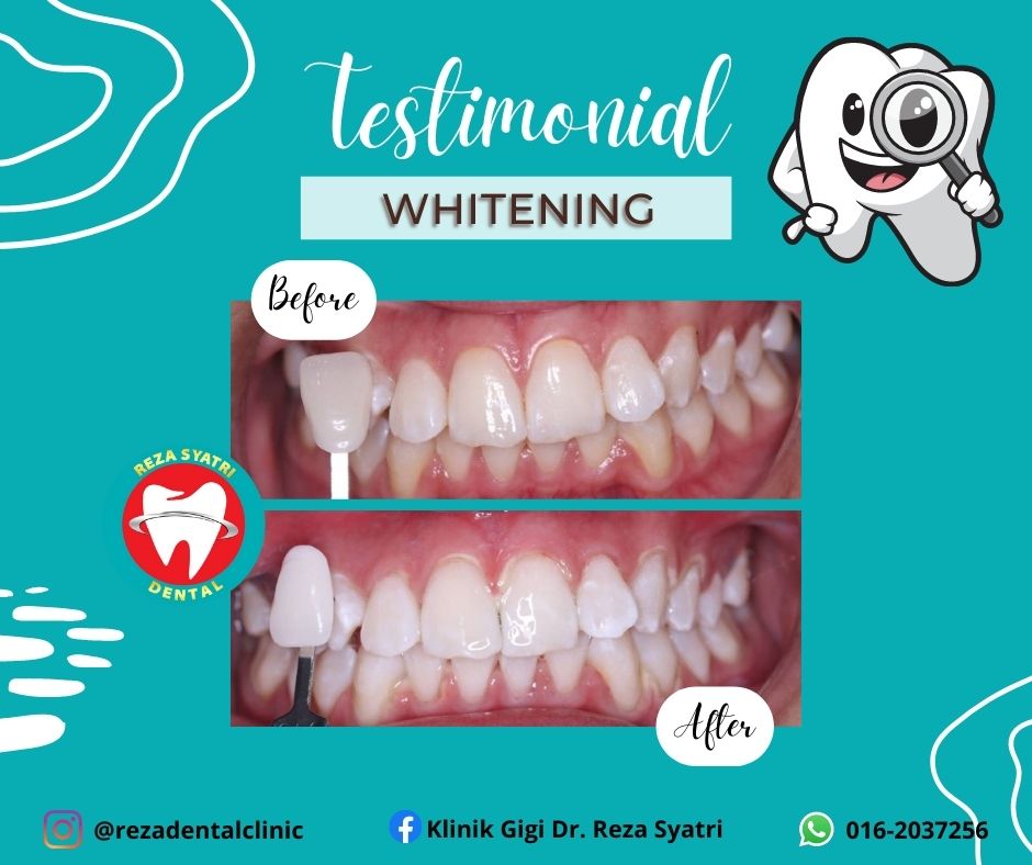 before after whitening (1)