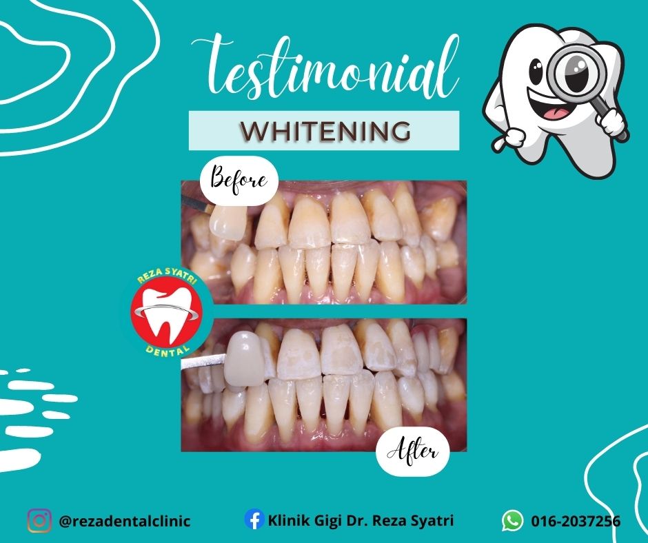 before after whitening (11)