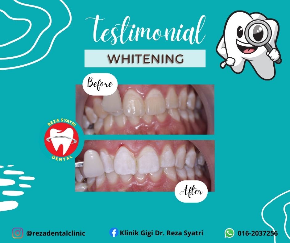 before after whitening (2)