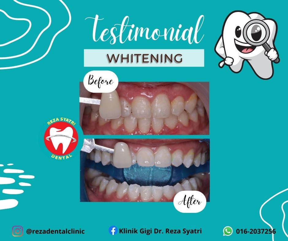 before after whitening (3)