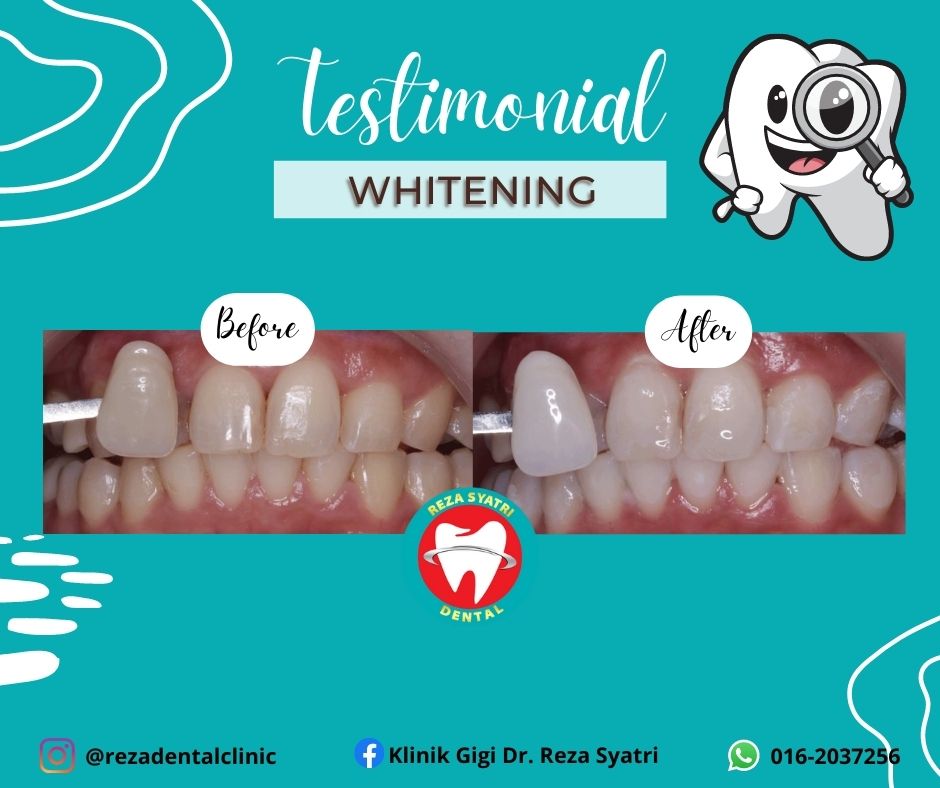 before after whitening (4)