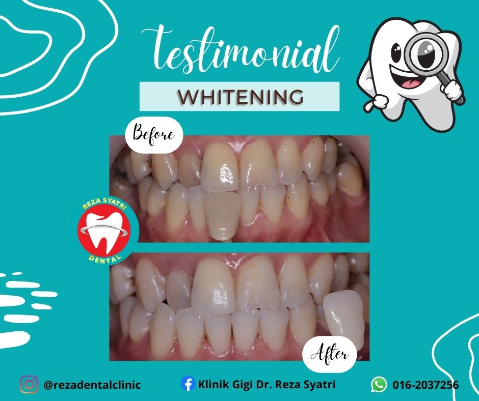 before after whitening (5)