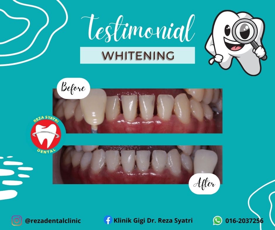 before after whitening (6)