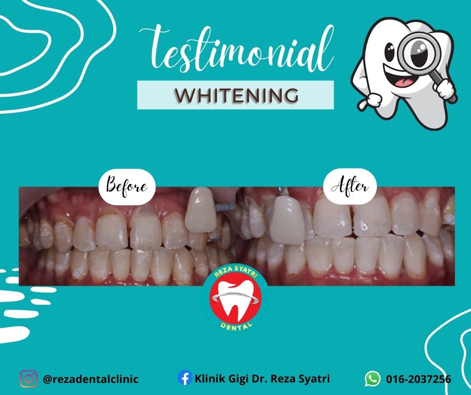 before after whitening (7)