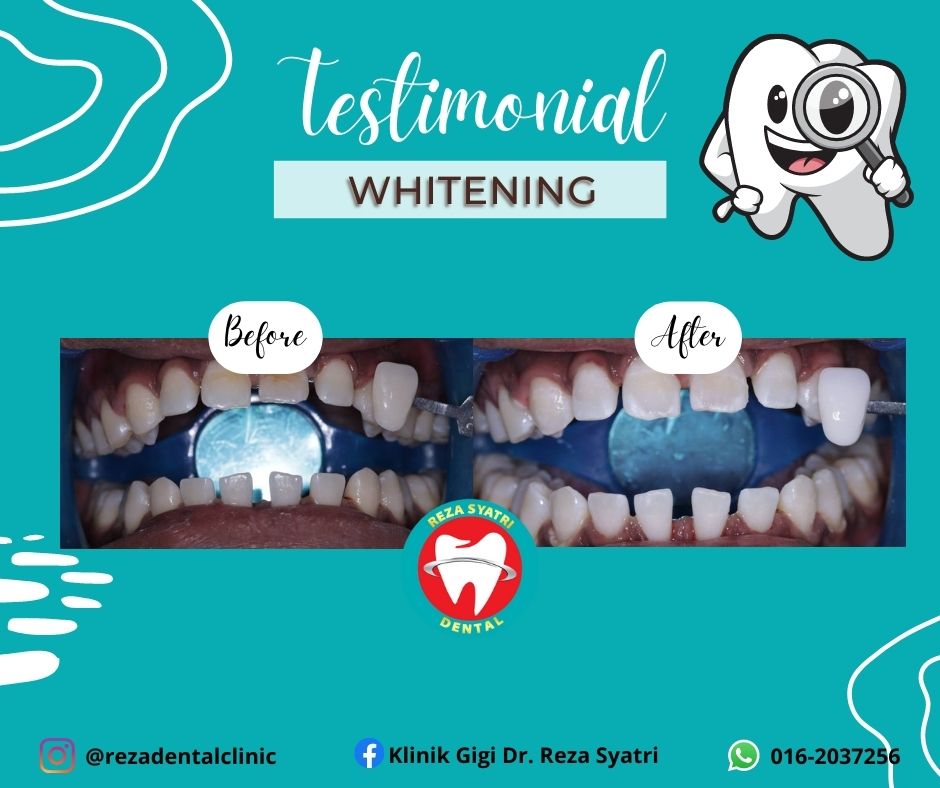 before after whitening (8)