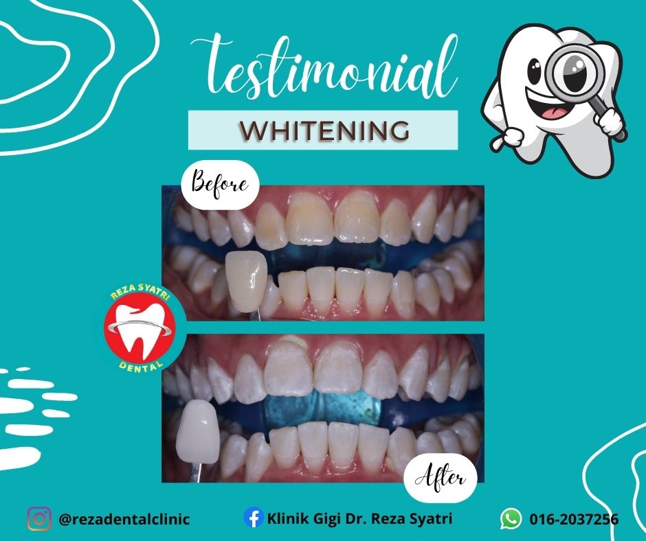 before after whitening (9)