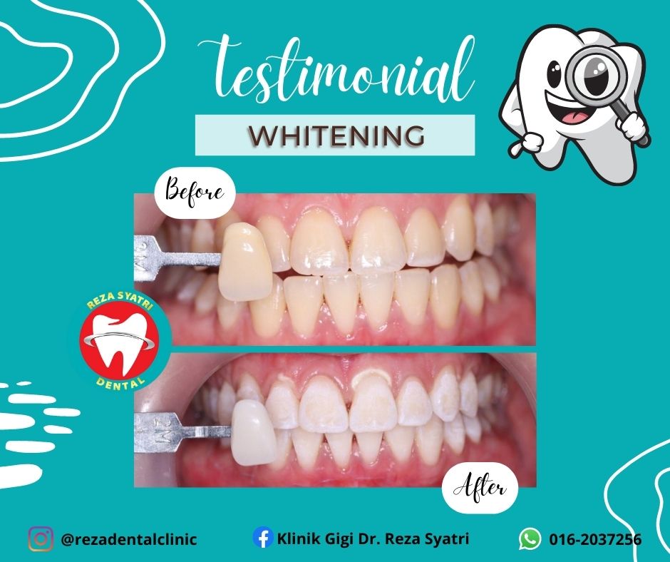 before after whitening